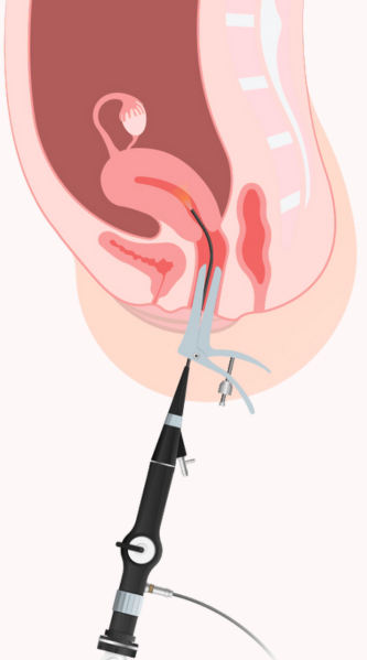 Dra Carmen Trota - Ginecologista em Juiz de Fora Especialista em Uroginecologia, PTGI, Microscopia Vaginal, Histeroscopia, Colposcopia, Climaterio e Menopausa Dra Carmen Trota Ginecologista em Juiz de Fora Ginecologista Ginecologia em Juiz de Fora Ginecologia Histeroscopia em Juiz de Fora Histeroscopia Colposcopia em Juiz de Fora Colposcopia Especialista em Menopausa Uroginecologista Uroginecologia Uroginecologista em Juiz de Fora